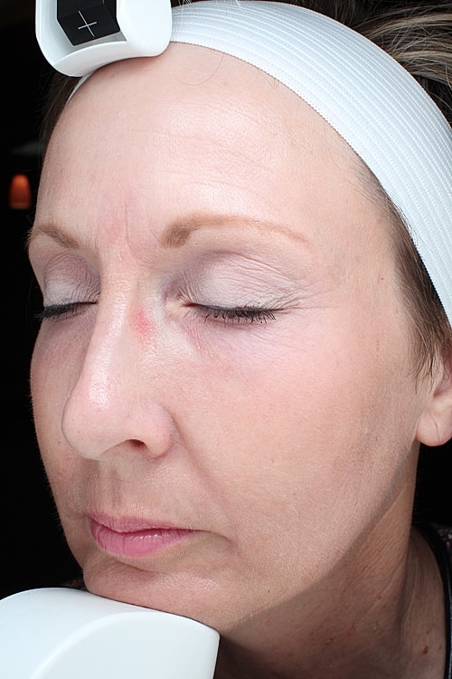 Facial Fat Transfer Before & After