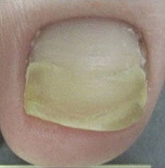 Toenail Fungus Removal Before & After