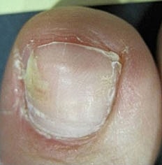 Toenail Fungus Removal Before & After