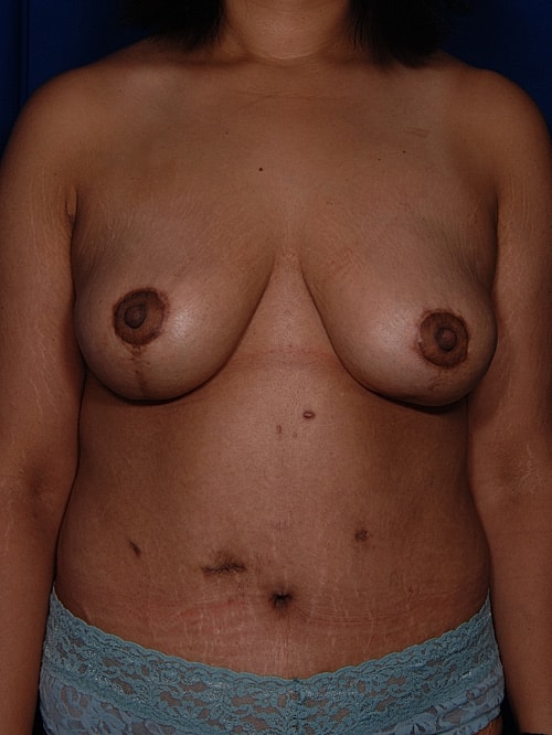 Breast Reduction Before & After