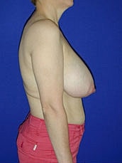 Breast Reduction Before & After