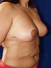 Breast Reduction Before & After