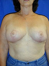 Breast Reduction Before & After