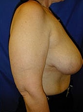 Breast Reduction Before & After