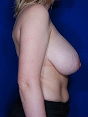 Breast Reduction Before & After