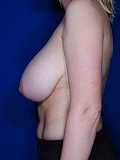 Breast Reduction Before & After