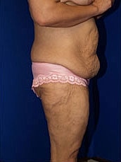 Body Lift Before & After