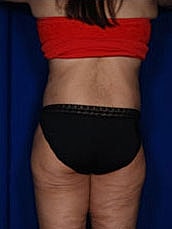 Body Lift Before & After