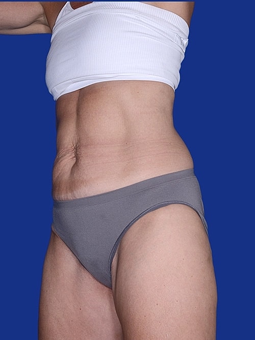 Body Lift Before & After