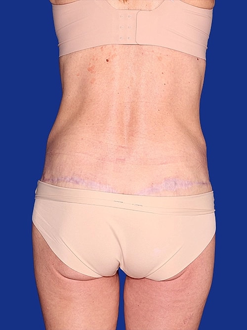 Body Lift Before & After