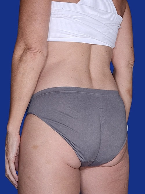 Body Lift Before & After