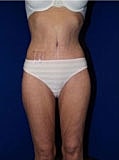 Body Lift Before & After