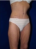 Body Lift Before & After