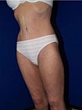 Body Lift Before & After
