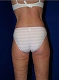 Body Lift Before & After