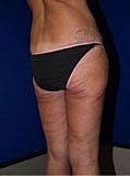 Body Lift Before & After