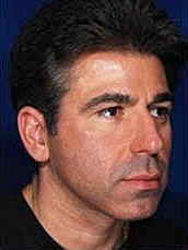 Male Rhinoplasty Before & After