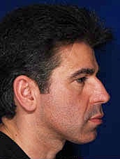 Male Rhinoplasty Before & After