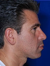 Male Rhinoplasty Before & After