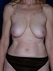 Breast Fat Transfer Before & After