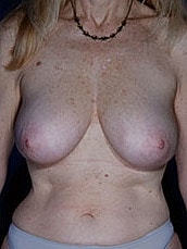 Breast Fat Transfer Before & After
