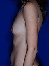 Breast Fat Transfer Before & After