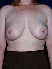Breast Fat Transfer Before & After