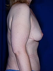 Breast Fat Transfer Before & After