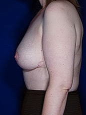 Breast Fat Transfer Before & After