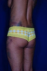 Brazilian Butt Lift Before & After