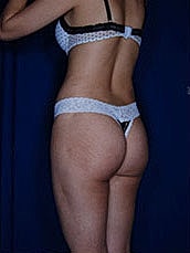 Brazilian Butt Lift Before & After