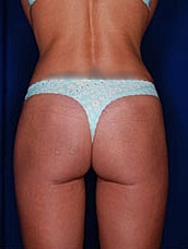 Brazilian Butt Lift Before & After