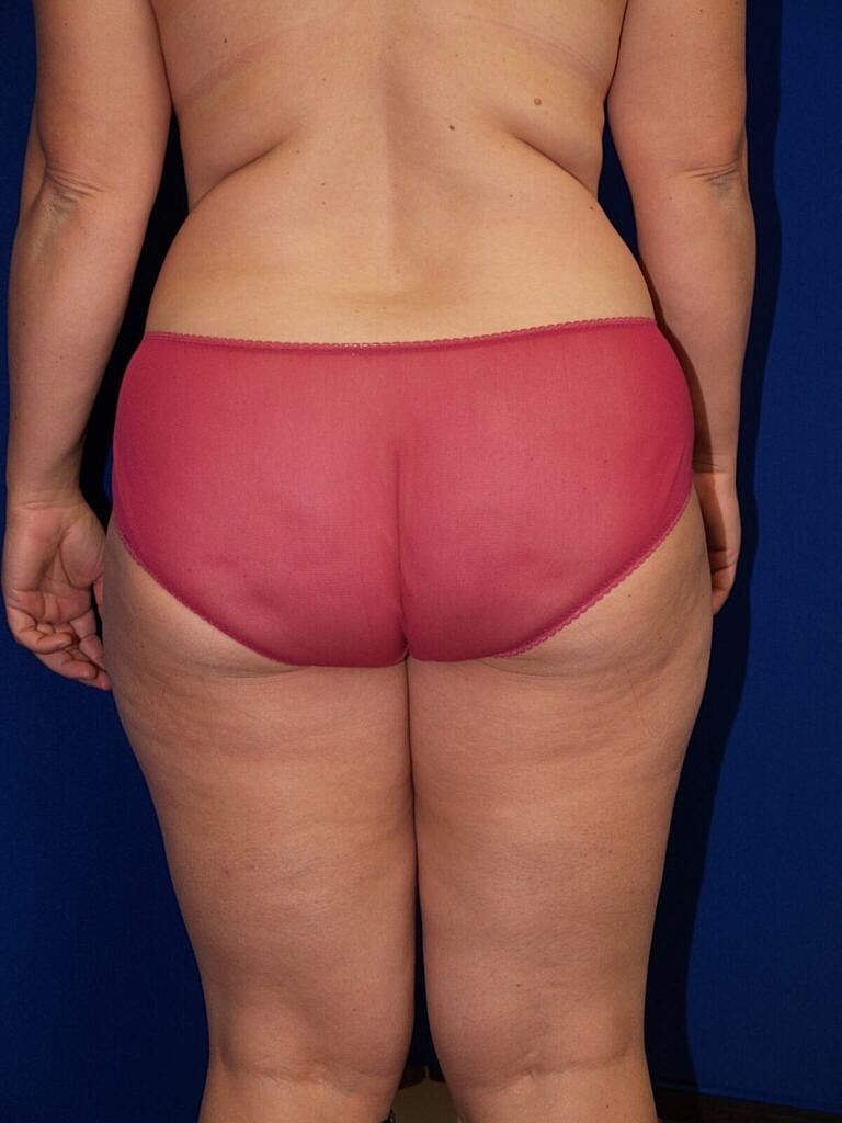 Brazilian Butt Lift Before & After