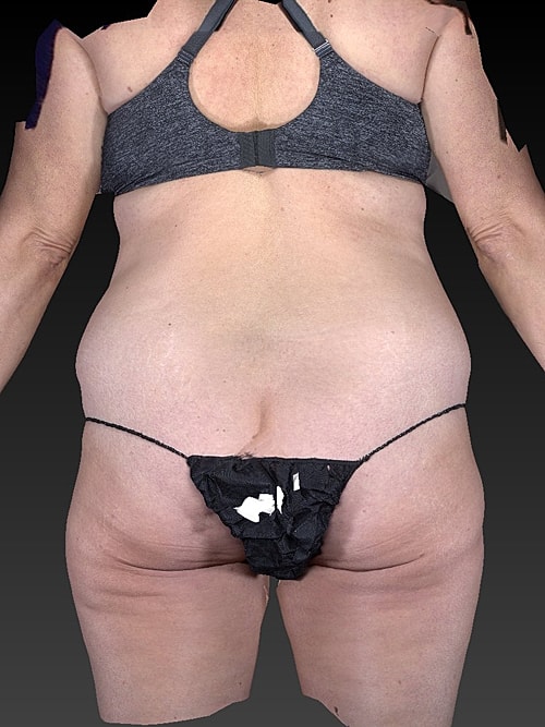 Brazilian Butt Lift Before & After