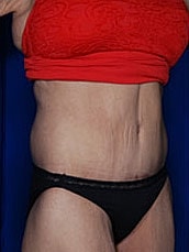 Post Weight Loss Surgery Before & After