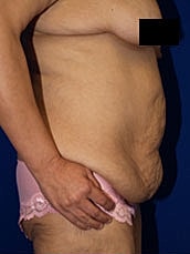 Post Weight Loss Surgery Before & After