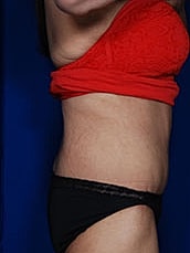 Post Weight Loss Surgery Before & After