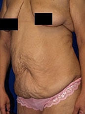 Post Weight Loss Surgery Before & After