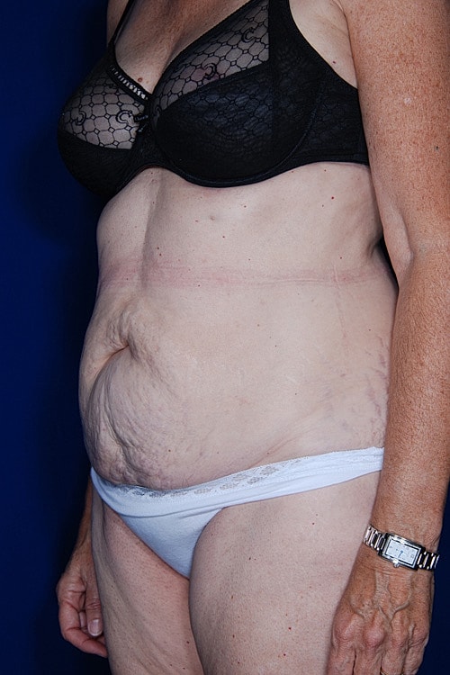 Post Weight Loss Surgery Before & After