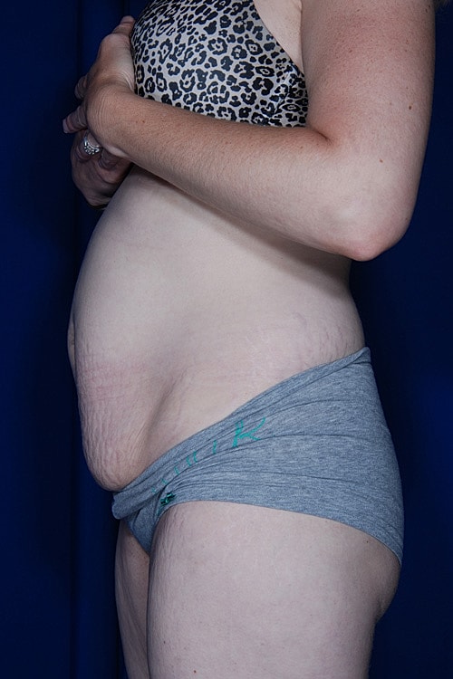 Post Weight Loss Surgery Before & After