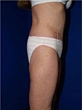 Post Weight Loss Surgery Before & After