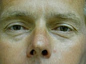 Male Eyelid Surgery Before & After