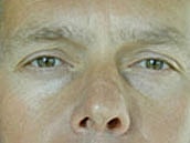 Male Eyelid Surgery Before & After