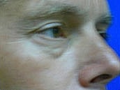 Male Eyelid Surgery Before & After