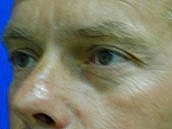 Male Eyelid Surgery Before & After