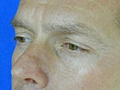 Male Eyelid Surgery Before & After