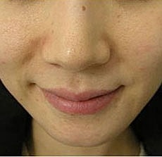 Vivace Before & After
