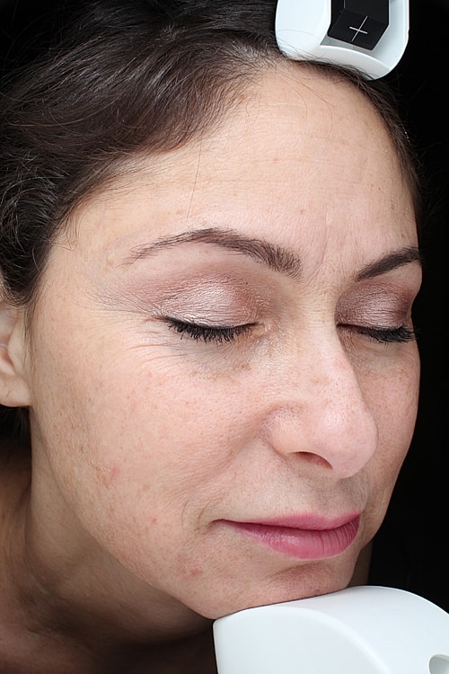 Laser Pigmentation Treatment Before & After