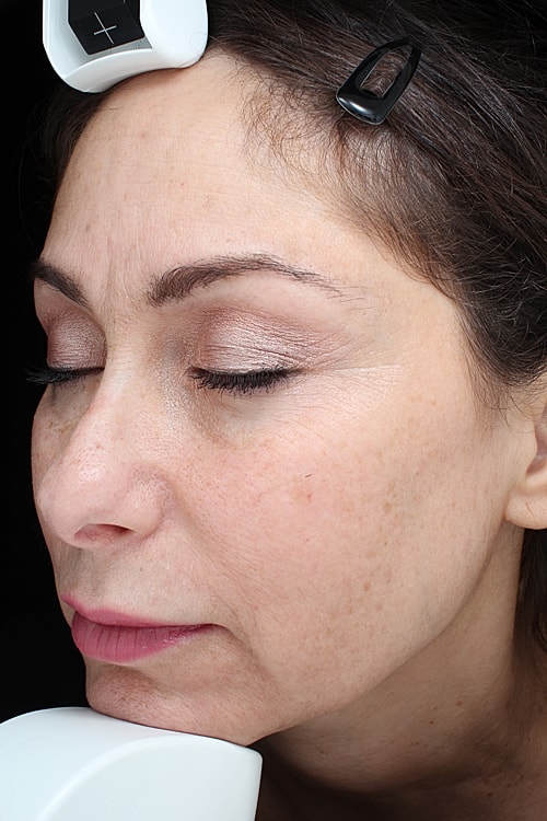 Laser Pigmentation Treatment Before & After
