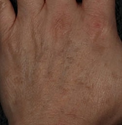 Laser Pigmentation Treatment Before & After